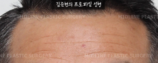 쌍꺼풀을 하려는데 이마주름이 심각해요....어떡하죠? 상남자의 자연스런 쌍꺼풀 만들기(Feat. 내시경 이마거상) 관련 이미지 2