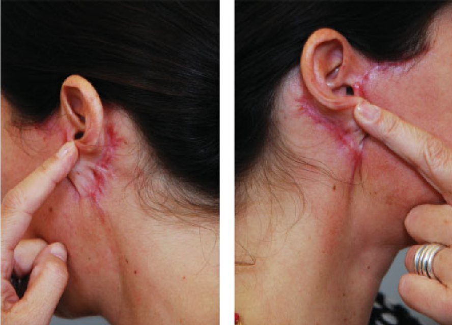 안면거상(Face lift, Rhytidectomy)에 대하여 성형외과 전문의가 알려드립니다. 관련 이미지 1
