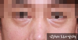 성형외과 전문의가 눈밑수술 케이스의 진단방법 및 나이들면 하는 수술이다라는 오해에 대해 설명해드립니다. 관련 이미지 1