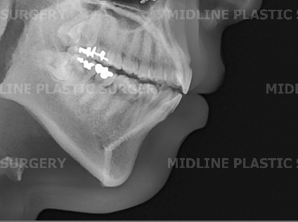 On the Effects of Advancement Genioplasty, Explained by a Board-Certified Plastic Surgeon. (feat. Rhinoplasty, Double Chin, Jawline Liposuction) image 7