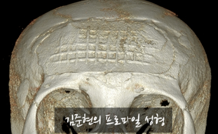 I Removed Two Forehead Implants. A Board-Certified Plastic Surgeon Explains Why I Do Not Recommend Forehead Implants. image 18