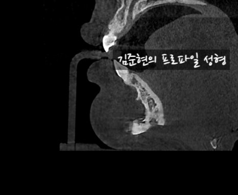 앞턱 보형물이 턱 옆으로 뚫고 나와요ㅠㅠ앞턱 보형물 제거 후 턱끝전진술을 한 케이스를 성형외과 전문의가 설명합니다. 관련 이미지 17