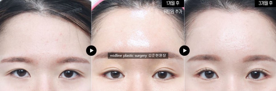 Headache, vomiting, pain, nausea after forehead lift... is it a side effect?! Here's my answer. image 9