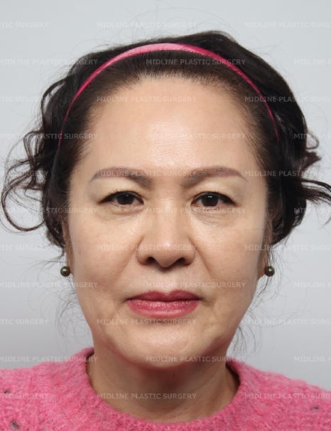 얼굴 주름 리프팅, 오래 지속되고 효과 좋은 수술방법은? 관련 이미지 7