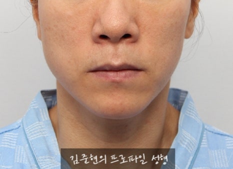 수술없이 간단하게 안면비대칭, 턱끝 비대칭(미드라인 맞추기) 해결하기!! 관련 이미지 10