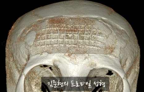 I Removed Two Forehead Implants. A Board-Certified Plastic Surgeon Explains Why I Do Not Recommend Forehead Implants. image 8