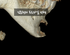 앞턱 보형물이 턱 옆으로 뚫고 나와요ㅠㅠ앞턱 보형물 제거 후 턱끝전진술을 한 케이스를 성형외과 전문의가 설명합니다. 관련 이미지 4