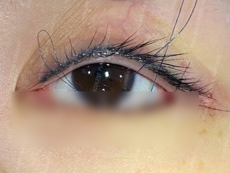 What Type of Plastic Surgery Is Needed for Small, Cramped Eyes? (About Lateral, Lower, and Combined Lateral-Lower Canthoplasty) image 22