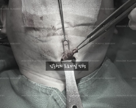 이중턱 근육 묶길 잘했어요^-^ 이중턱 근육묶기와 근육 밑 지방(포도송이 지방)제거까지 성형외과 전문의가 설명드립니다. 관련 이미지 5