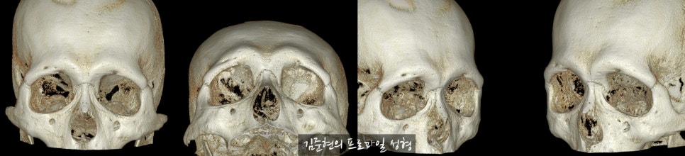 눈썹뼈절삭, 어떨 때 어떻게 하는 수술일까요? 꼭 이마거상과 함께 해야만 하는 수술인가요? 미드라인성형외과에서 하는 눈썹뼈절삭 수술을 설명드립니다. (3D CT 있음) 관련 이미지 15