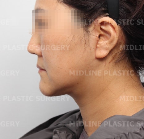About Face Lifts That Are Effective for Improving Mouth Corners, Neck Wrinkles, and Cheek Sagging image 13