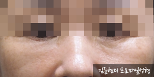 성형외과 전문의가 눈밑수술 케이스의 진단방법 및 나이들면 하는 수술이다라는 오해에 대해 설명해드립니다. 관련 이미지 14