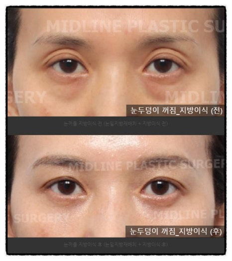 Sallow Eyes, Sunken Eyes Solved with Fat Grafting! (Feat. Dark Circles) image 5