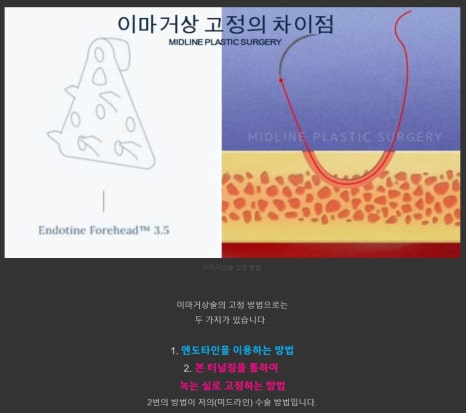 멀티 내시경이마거상술 vs 일반 이마거상술 차이점! 관련 이미지 1