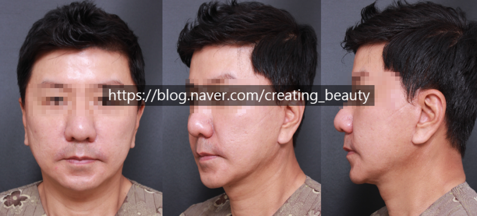 안면거상(Face lift, Rhytidectomy)에 대하여 성형외과 전문의가 알려드립니다. 관련 이미지 13