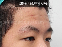 How Can Deep Forehead Wrinkles Be Resolved? (Feat. Forehead Lift + Filler) image 7