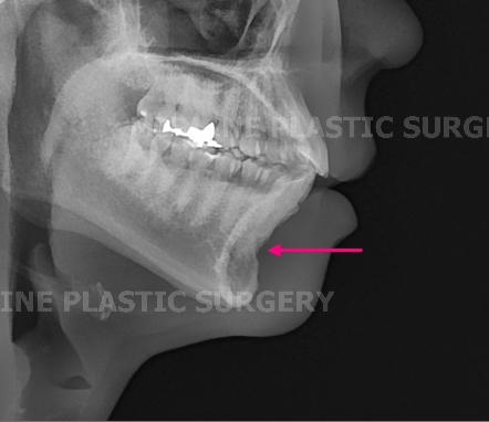 A Specialist Explains Chin Advancement Surgery After Removal of a Receded Chin Implant image 2