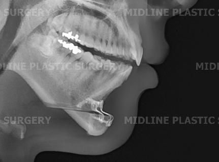 On the Effects of Advancement Genioplasty, Explained by a Board-Certified Plastic Surgeon. (feat. Rhinoplasty, Double Chin, Jawline Liposuction) image 8