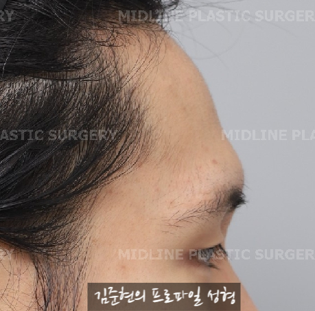 눈썹뼈절삭, 어떨 때 어떻게 하는 수술일까요? 꼭 이마거상과 함께 해야만 하는 수술인가요? 미드라인성형외과에서 하는 눈썹뼈절삭 수술을 설명드립니다. (3D CT 있음) 관련 이미지 9