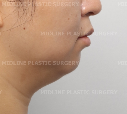 On the Effects of Advancement Genioplasty, Explained by a Board-Certified Plastic Surgeon. (feat. Rhinoplasty, Double Chin, Jawline Liposuction) image 9
