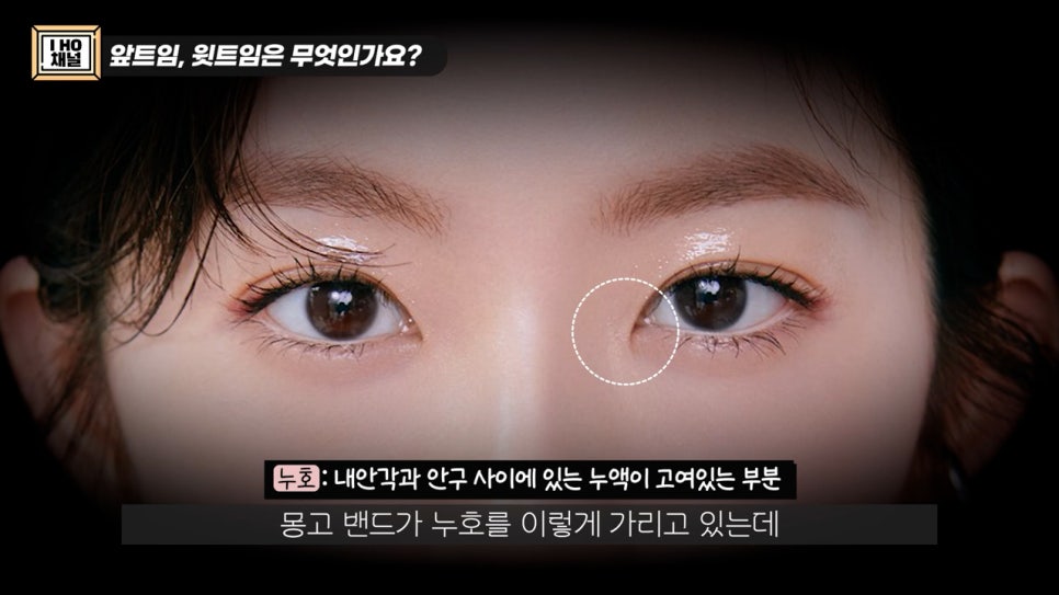 앞트임, 윗트임 하지 말아야할 눈!! 관련 이미지 4