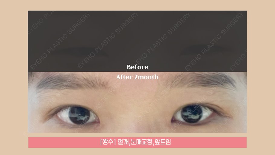 꼬막눈쌍수 시원하게 개선하려면 관련 이미지 15