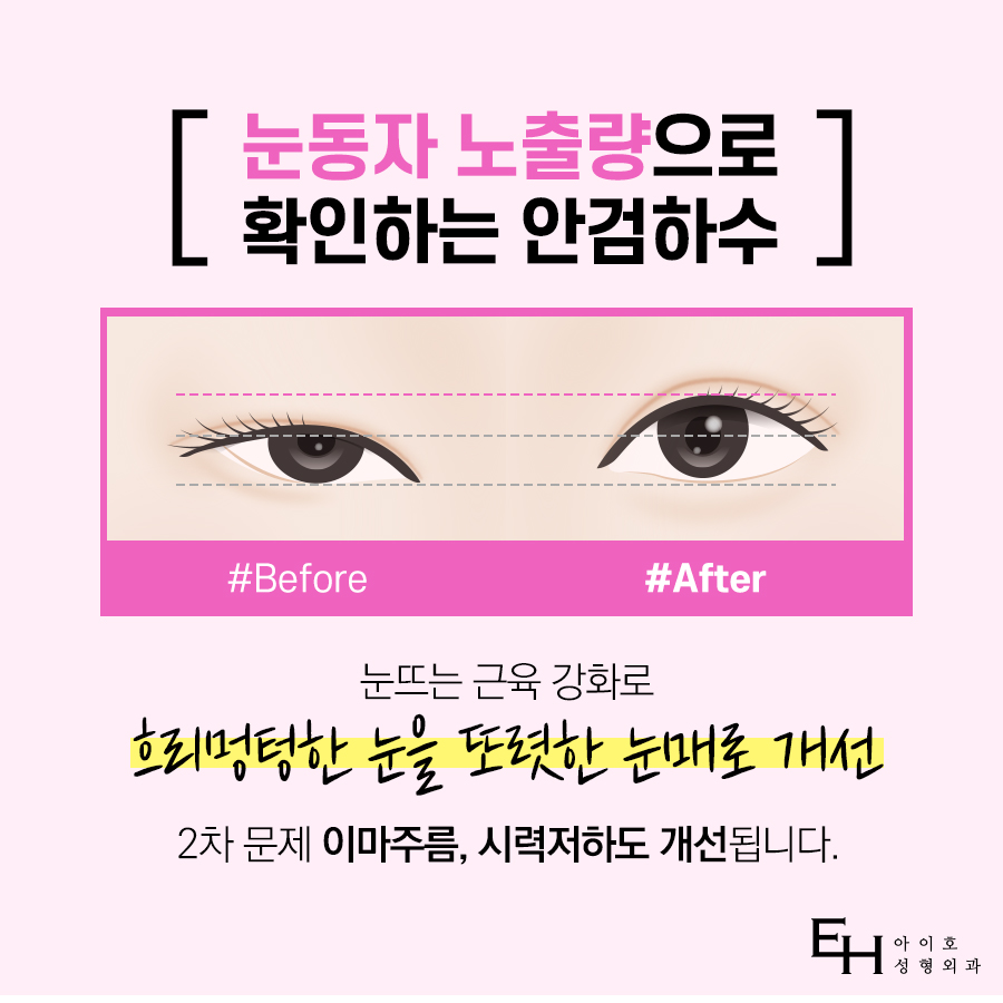 눈매교정수술전후 호감 가는 인상을 위해 맞춤형으로 관련 이미지 3