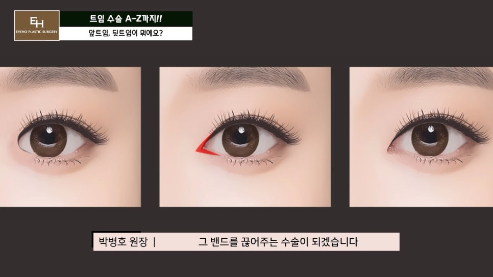 Everything About Canthoplasty, Explained by IHO image 11