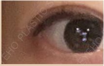 Changed Appearance Before and After Eye Revision Surgery image 36