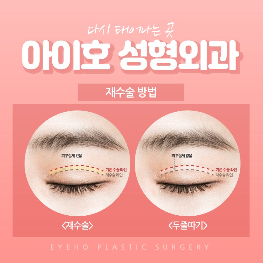 쌍꺼풀재수술비용 실패 원인 파악해보고 관련 이미지 3