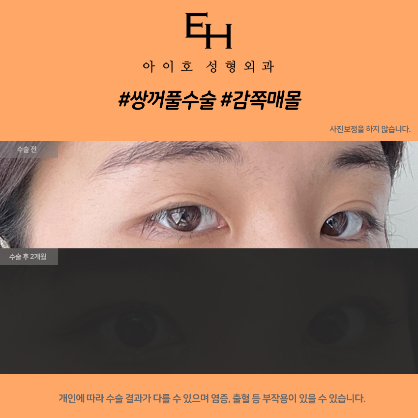 [눈성형종류] 눈찝기 풀어질 확률을 줄이고 싶다면 관련 이미지 4