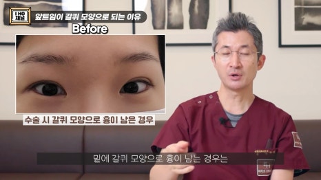 앞트임, 윗트임 하지 말아야할 눈!! 관련 이미지 44