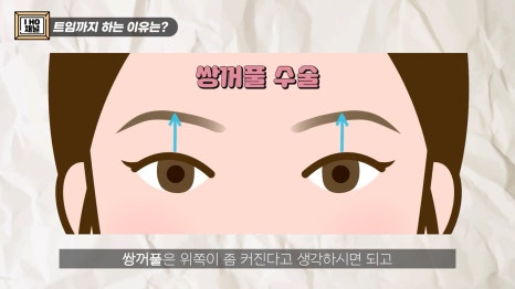 Do Double Eyelid Surgery and Canthoplasty Have to Be Done Together? image 6