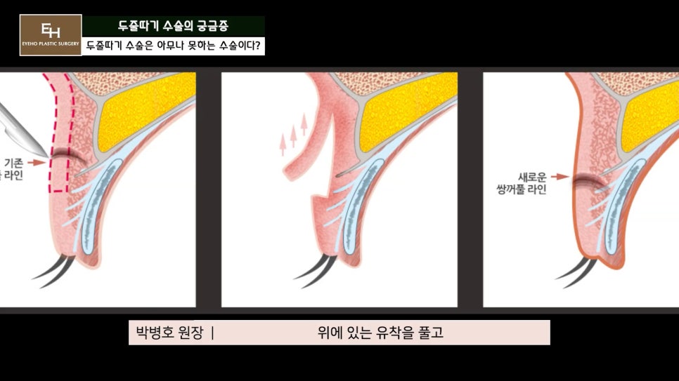 더 이상 물러설 때가 없는 재수술 두줄따기 궁금해요! 관련 이미지 13