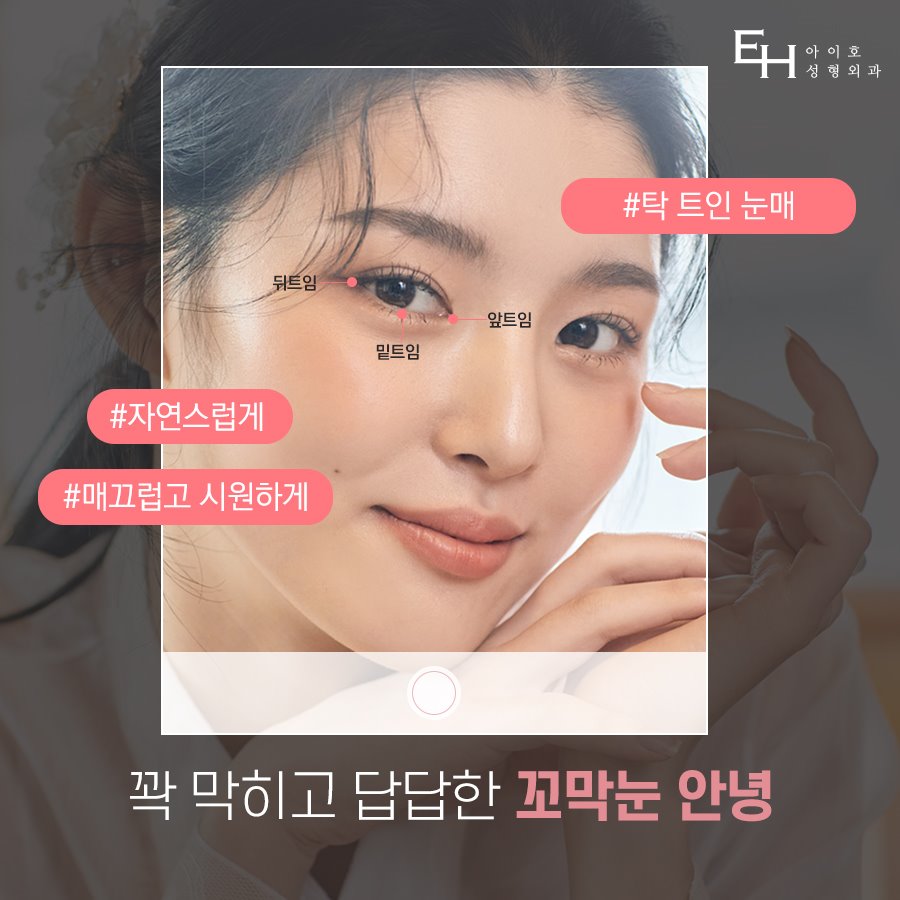 [눈수술 종류] 트임성형 자연스럽게 시원하게 관련 이미지 1