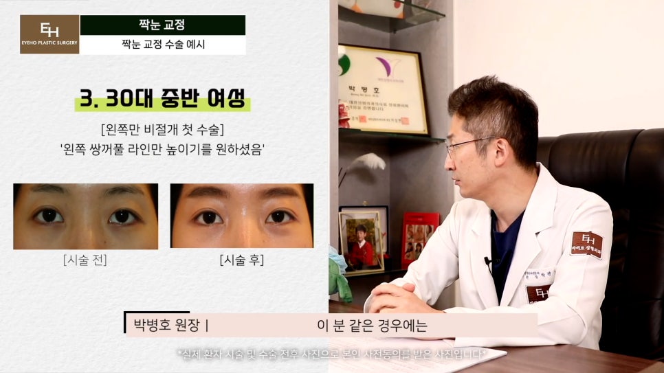 짝눈이 고민인데 양쪽 눈 수술하기 싫어요!! 한쪽 눈만 수술 가능!? 관련 이미지 11