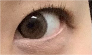 눈재수술비용 어떨때 개선해야 하나요? 관련 이미지 21