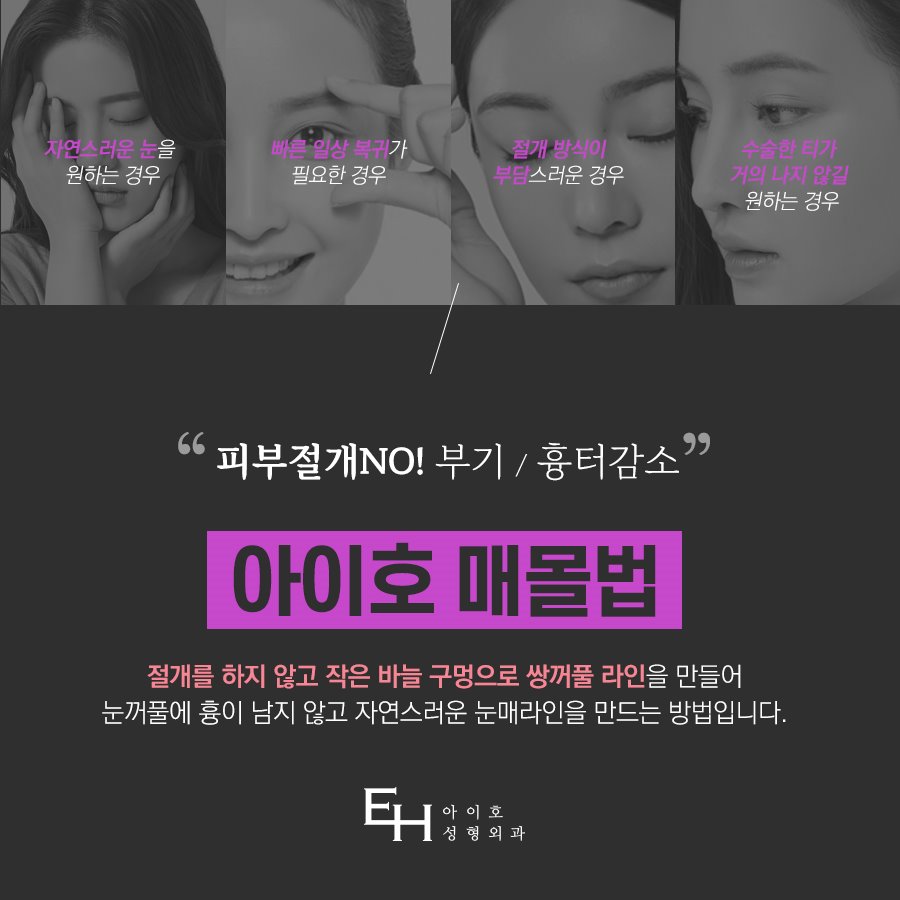 쌍수매몰법 매력적인 나만의 라인으로 관련 이미지 2