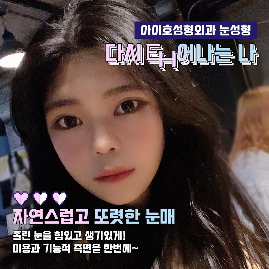 속쌍눈매교정 성공을 위해 전후 비교 관련 이미지 1
