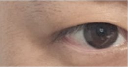 For a Natural Eye Shape Before and After Male Eye Surgery image 21