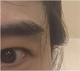 남자 눈매교정 가격 및 남자 눈매교정 전후 차이 비교 분석 관련 이미지 22