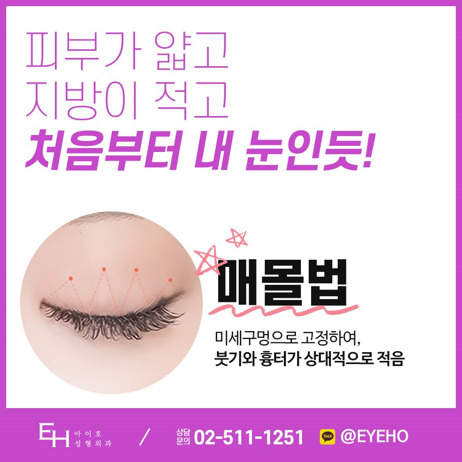 쌍수매몰법 매력적인 나만의 라인으로 관련 이미지 4