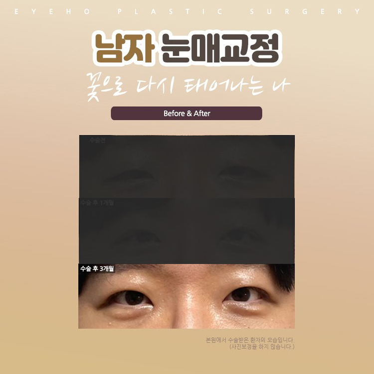 Natural and Harmonious Male Double-Eyelid Correction image 7