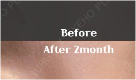 Changed Appearance Before and After Eye Revision Surgery image 34