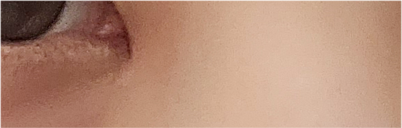 쌍수매몰법 매력적인 나만의 라인으로 관련 이미지 25