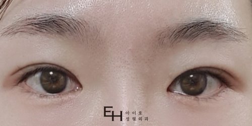 Double Eyelid Surgery with the Buried Suture Method: No Need to Worry About Swelling image 14