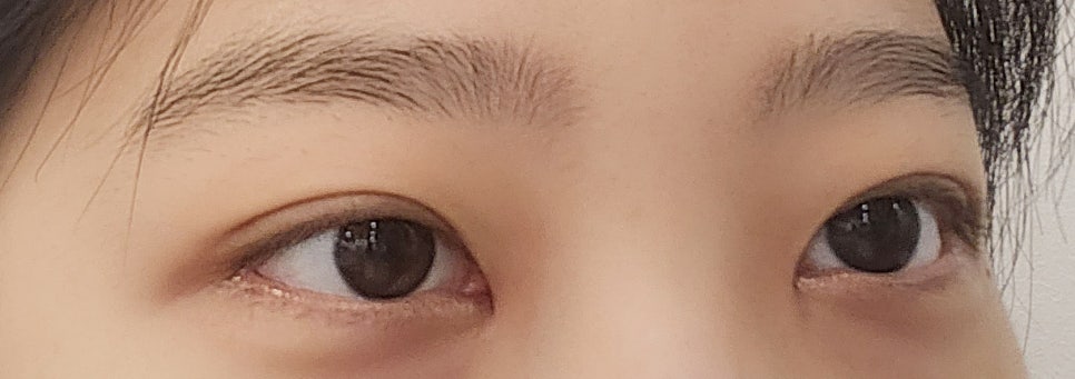 쌍수매몰법 매력적인 나만의 라인으로 관련 이미지 17