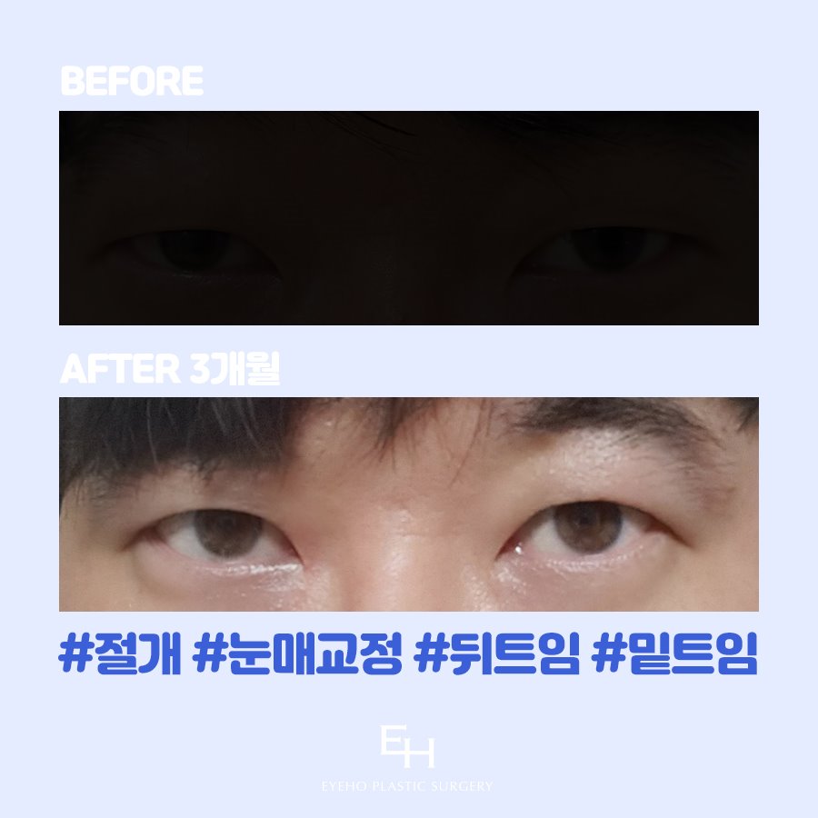 남자 눈성형 쌍꺼풀 후 비교 관련 이미지 17
