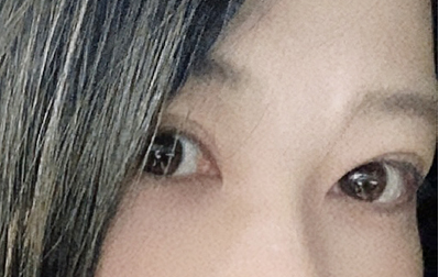 눈재수술비용 원인 파악을 우선으로 관련 이미지 18