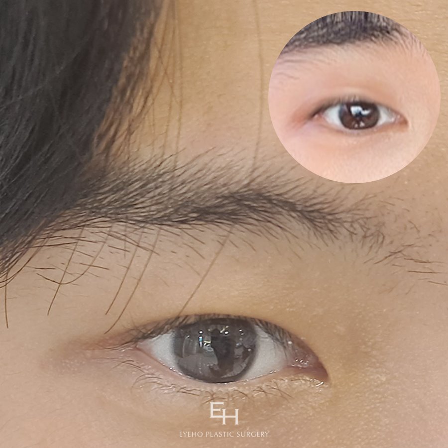 남자눈매교정전후 세세하게 파악해보면서 관련 이미지 14